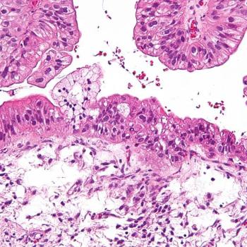 Micrograph of a mucinous ovarian tumor (Photo National Institutes of Health)