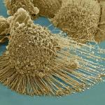 A dying cancer cell with filopodia stretched out to its right. The protrusions help cancer migrate. Stock NIH NCMIR image. The image does not display a cell treated in the Georgia Tech study. Credit: NIH-funded image of HeLa cell / National Center for Mic