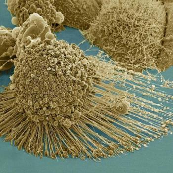 A dying cancer cell with filopodia stretched out to its right. The protrusions help cancer migrate. Stock NIH NCMIR image. The image does not display a cell treated in the Georgia Tech study. Credit: NIH-funded image of HeLa cell / National Center for Mic